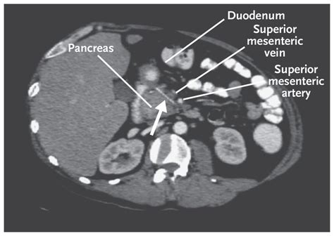 RadRounds Radiology Network On Twitter Patient Septic W Fever Of