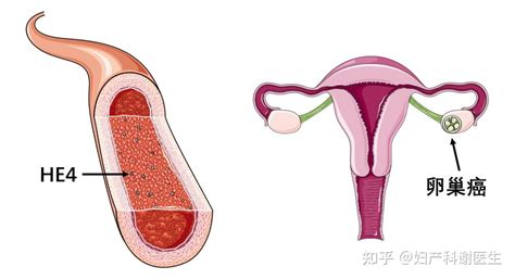 卵巢癌与肿瘤标志物 人附睾蛋白4 He4 篇 知乎