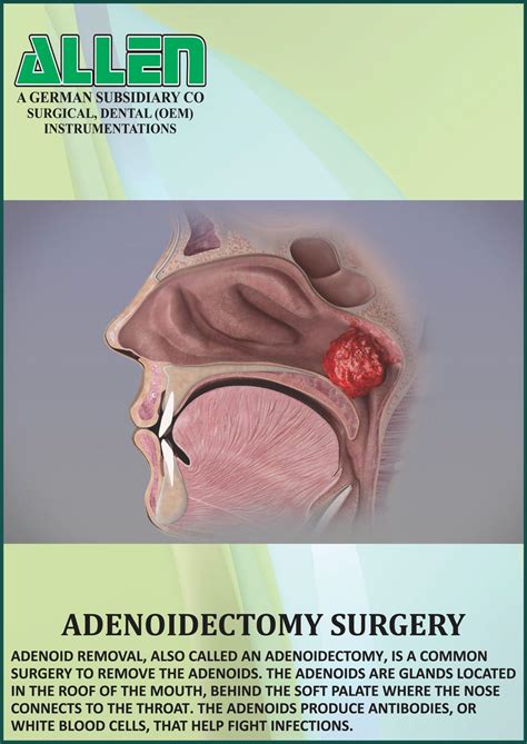 Adenoids Surgery