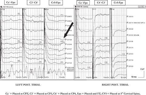 Posterior Tibial Nerve Somatosensory Evoked Potential Ssep Stack Data