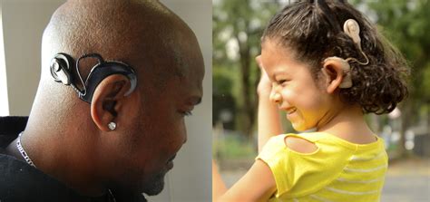 Cochlear Implants Ui Health