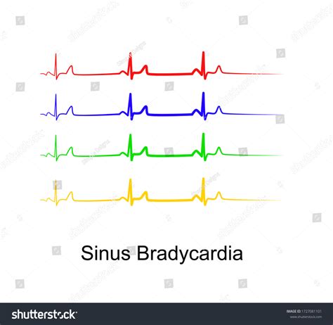 Sinus Bradycardia Ecgsb Bradycardia Heart Rate Stock Vector Royalty