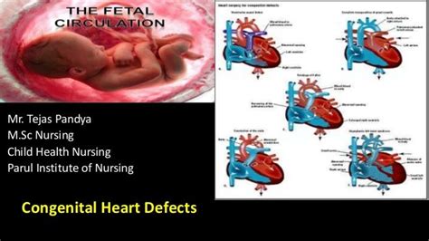 Congenital Heart Defects