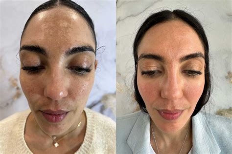 Cosmelan Peel Harley Street London Depigmentation Peel