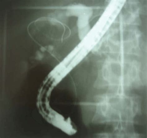 Ercp Showed Dilation Of Intrahepatic Bile Ducts Download Scientific Diagram