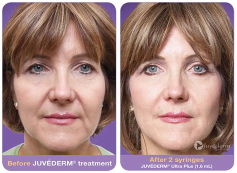 Dermal Fillers Juvederm Ultra Plus Xv And Voluma Xc Pearland Med Spa