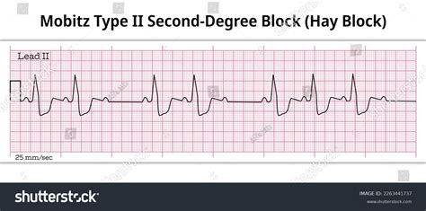 Hay Block - ECG Mobitz Type 2 Second Degree - Royalty Free Stock Vector ...