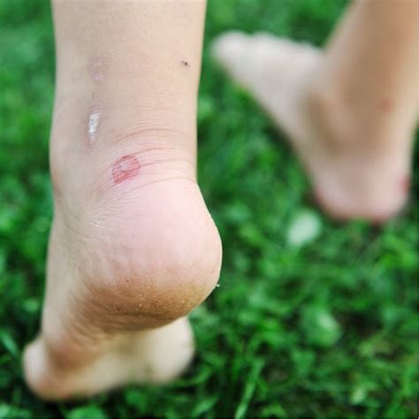 Infected Blister On Top Of Foot Best Sale | emergencydentistry.com