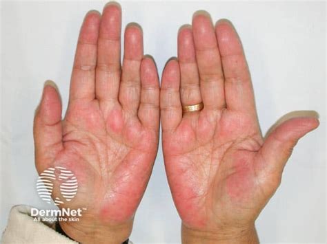 Palmar Erythema Images — Dermnet