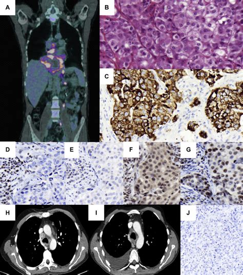 A Mismatch RepairDeficient Hepatoid Adenocarcinoma Of The Lung