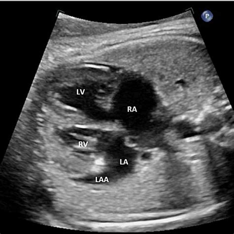 Pulmonary Veins Echo