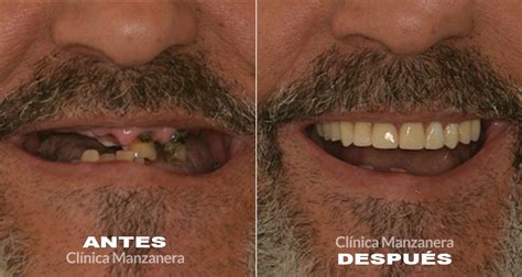 Implantes Inmediatos Tu Sonrisa En Horas Caso Real Clinica