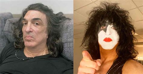 Paul Stanley Ear Deformity