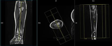 Forearm Mri Protocols And Planning Indications For Mri Forearm