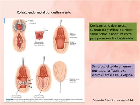 Abscesos Fistulas Anales Y Quiste Pilonidal Ppt