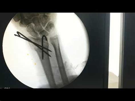 K Wire Distal Radius Fracture Kapandji Technique Dr Prateek Joshi