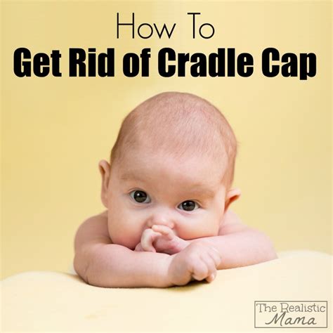 How To Get Rid Of Cradle Cap The Realistic Mama