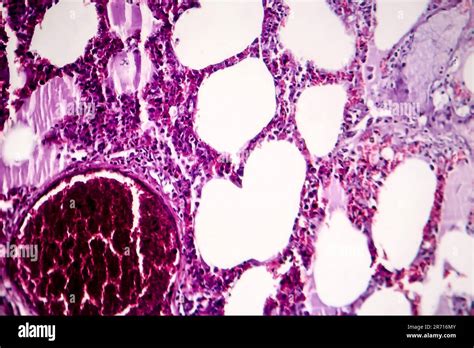 Histopathology Of Pneumonia Light Micrograph Photo Under Microscope