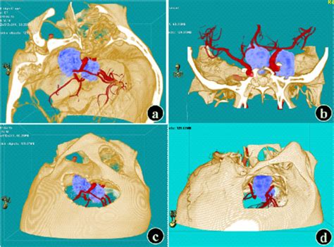 Preoperative Simulation Of A Model Of Cavernous Hemangioma In The