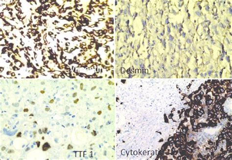 Photomicrograph Showing Immunohistochemistry Resultscytokeratin And