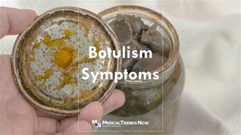 Botulism Symptoms A Silent Killer Medical Trends Now