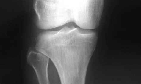 Daily Dose: Segond fracture