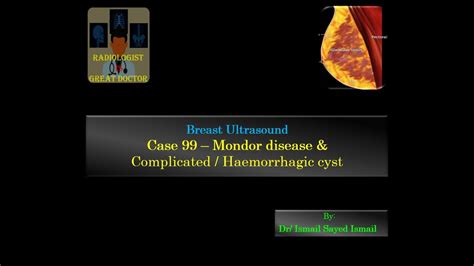 Ultrasound Case 99 Mondor Disease And Haemorrhagic Breast Cyst Youtube