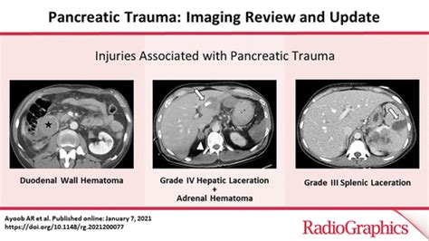 Pancreatic Trauma Imaging Review And Management Update Radiographics