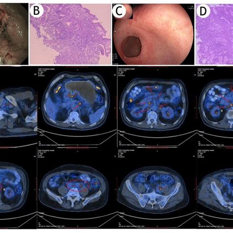 A Gastric Ulcer Was Found During Gastroscopy B Pathological Ndings Download Scientific