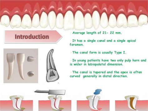 Maxillary Molar Access Cavity