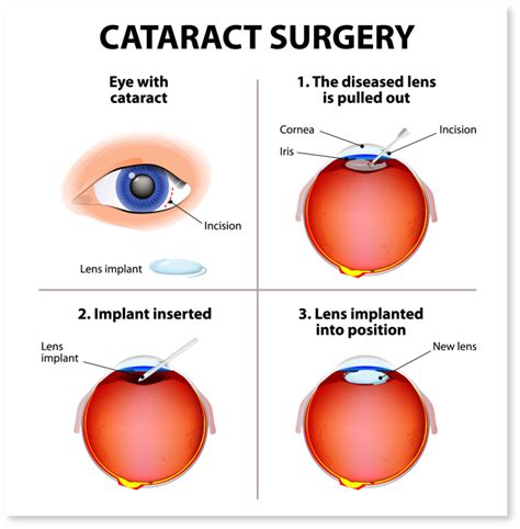 Cataract Operation 1960 Eye Surgeons Houston Tx