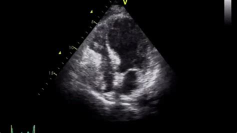 Takotsubo Cardiomyopathy Right Ventricular Involvement Youtube