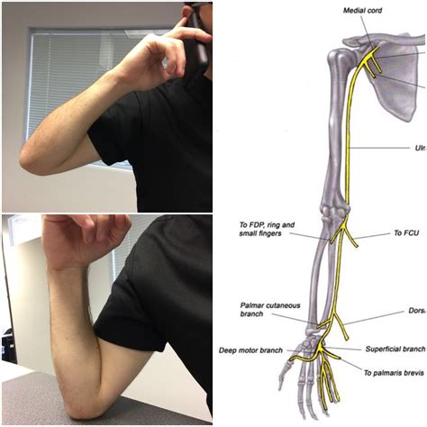 Cubital Tunnel Syndrome EMG NCV