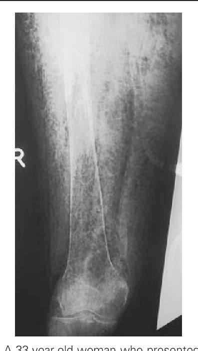 Figure 1 From Tropical Pyomyositis And Necrotizing Fasciitis Semantic