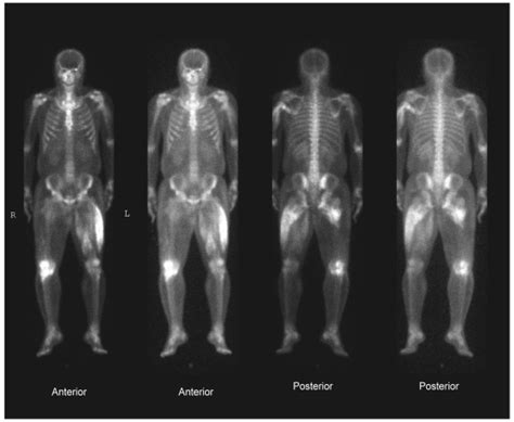 Technetium M Hdp Whole Body Bone Scan Focal Soft Tissue Uptakes Are