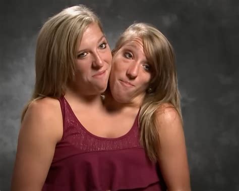 Conjoined Twin Abby Hensel From Abby Brittany Privately Married Army