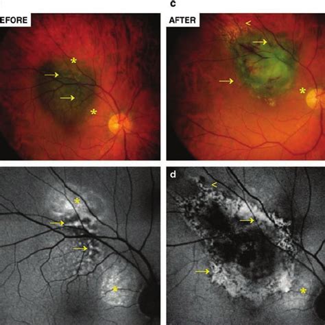 Patient 2 Right Eye Colour Fundus Photograph A And C And Fundus Download High Quality