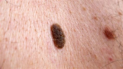 Skin Cancer Rash: Itchiness and Symptoms