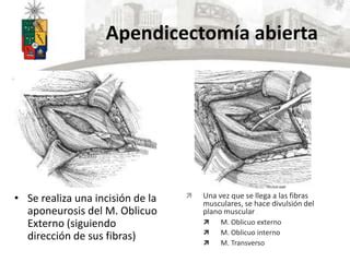 Apendicectom A Abierta Y Vlp Ppt