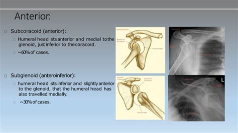 Shoulder Dislocation Types And Management Methods Of Reduction Ppt