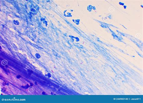 Mycobacterium Tuberculosis Positive Small Red Rod In Sputum Smear Stock