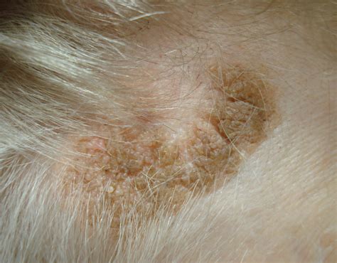 nevus sebaceous pictures - pictures, photos