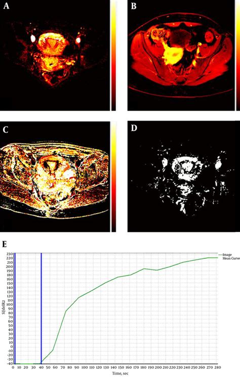 Quantitative Dynamic Contrast Enhanced Magnetic Resonance Imaging In