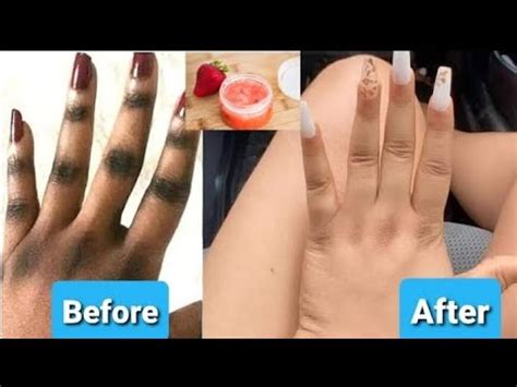 How To Get Rid Of Dark Knuckles Naturally Fast Home Remedy For Dark