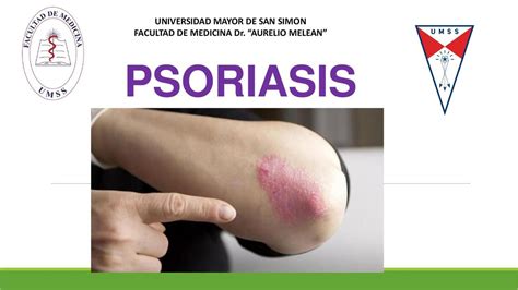 Psoriasis Medicina Eli UDocz