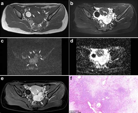 The Value Of Mri For Differentiating Benign From Malignant Sex Cord Stromal Tumors Of The Ovary