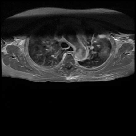 Intradural Cystic Schwannoma Image Radiopaedia Org