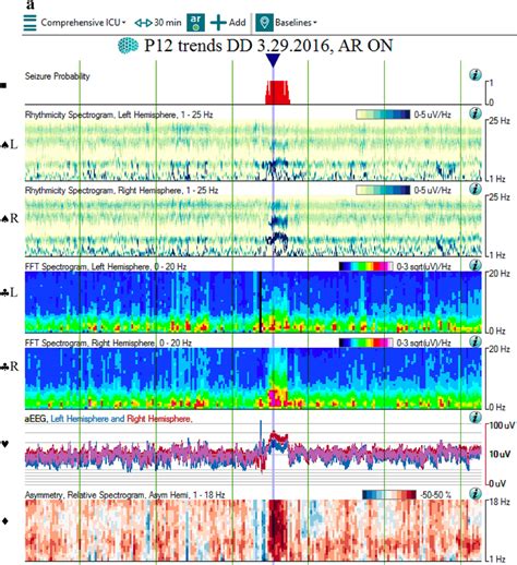 QEEG And Raw EEG Of A Right Hemispheric Focal Seizure A The QEEG Shows