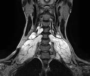 Plexiform Neurofibroma Radiology Reference Article Radiopaedia Org