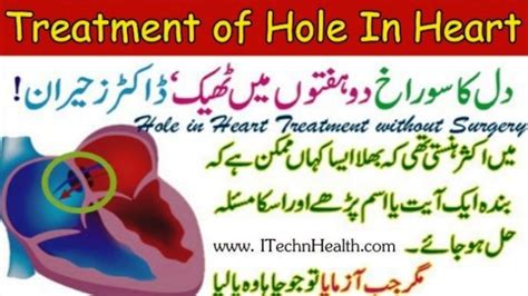 Treatment of Hole in Heart without Heart Surgery - iTechnHealth.com